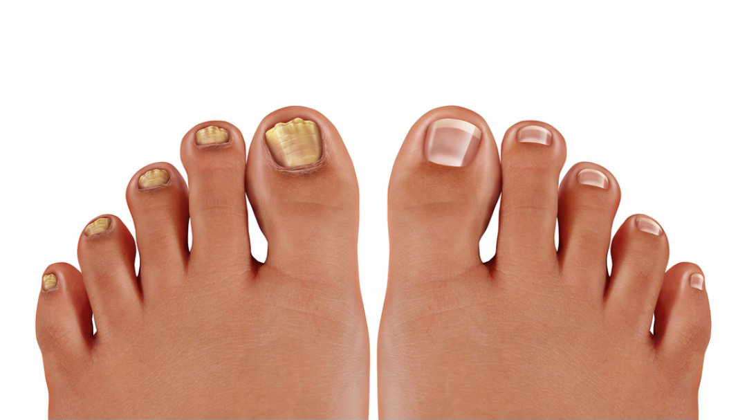 Affrontare le Onicomicosi: Una Guida Completa alla Gestione delle Infezioni Fungine delle Unghie